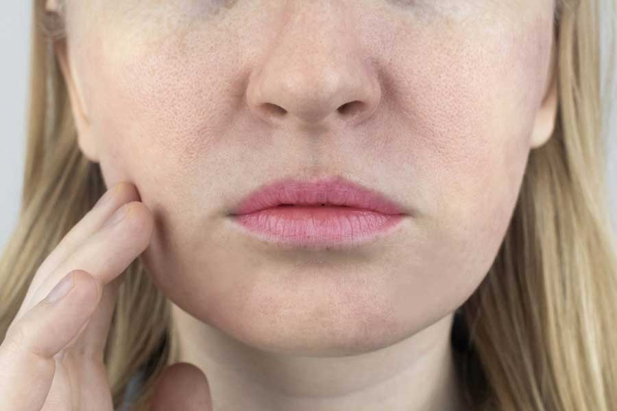 Rosacea na de behandeling vrouw