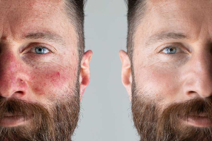 Rosacea voor en na man