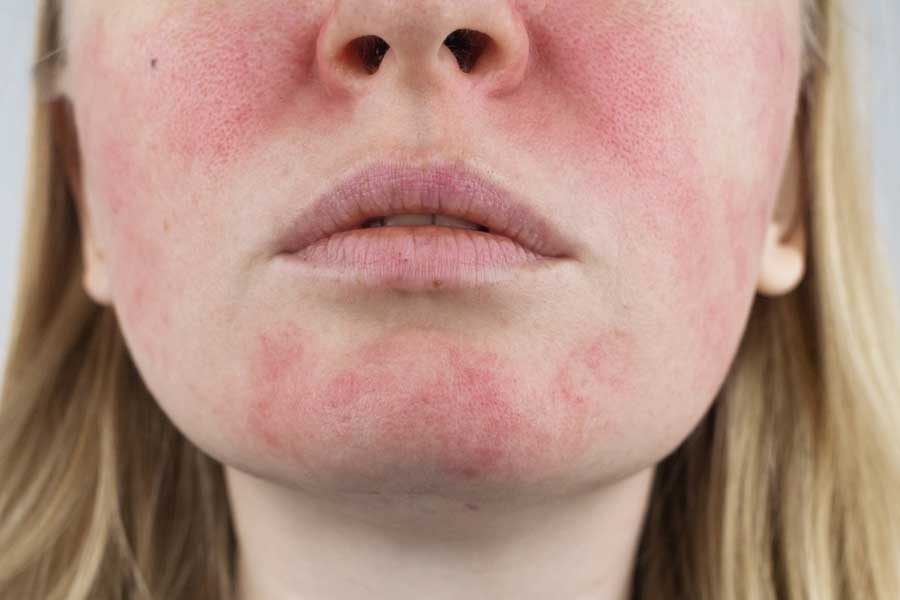 Rosacea before the treatment woman