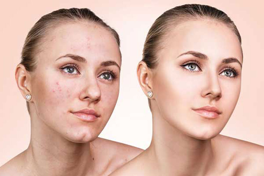 Acne voor en na