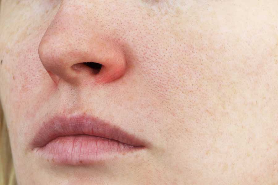 Rosacea after treatment